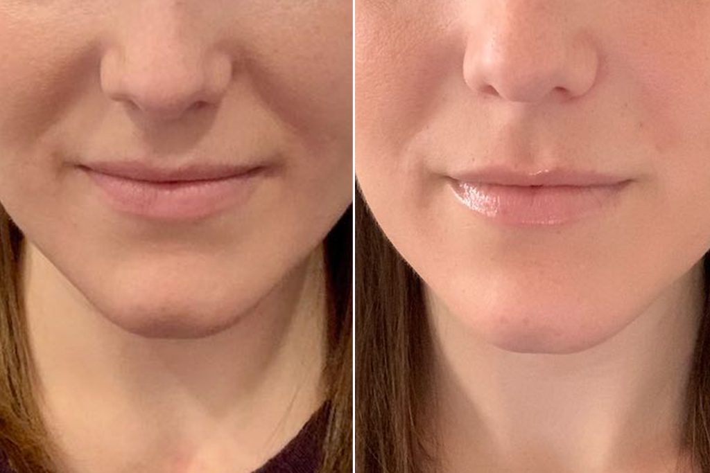 Botox for Smile Lines Before and After