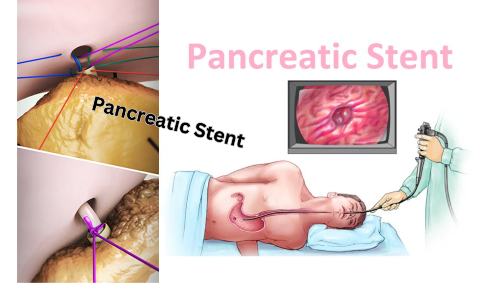 Pancreatic Stent Updated