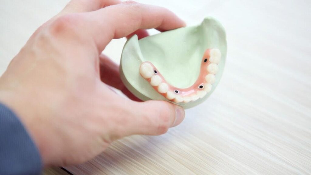 Dental Implants